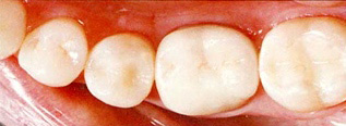 銀歯と白い歯の違いは？
