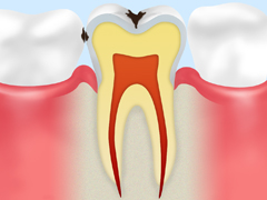 C1　エナメル質に留まる虫歯