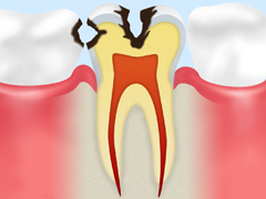 C2　象牙質に及んだ虫歯